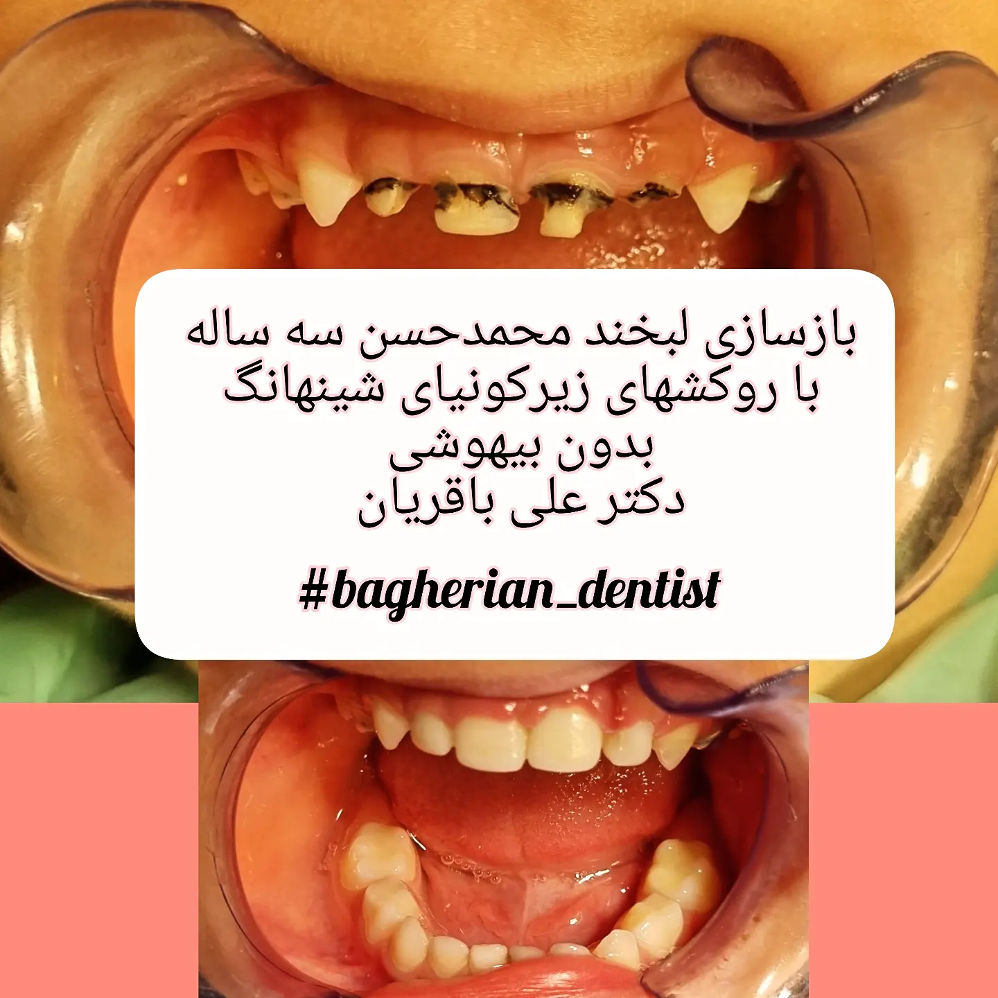 <p style="text-align:center;"><span style="color:hsl(240,75%,60%);"><strong>بازسازی لبخند محمدحسن سه ساله بدون بیهوش &nbsp;با استفاده از درمان عصب و رو کشهای سرامیکی زیرکونیا(پس از توقف پوسیدگی در یک و نیم سالگی با نقره فلوراید)</strong></span></p>